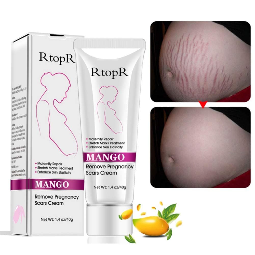 Stretch Mark Scar Cream, Remove Pregnancy Scars,Stretch Marks Treatment, Maternity Repair,Remove Stretch Marks from Pregnancy, Repair Scar Slack Line Abdomen Stretch Marks