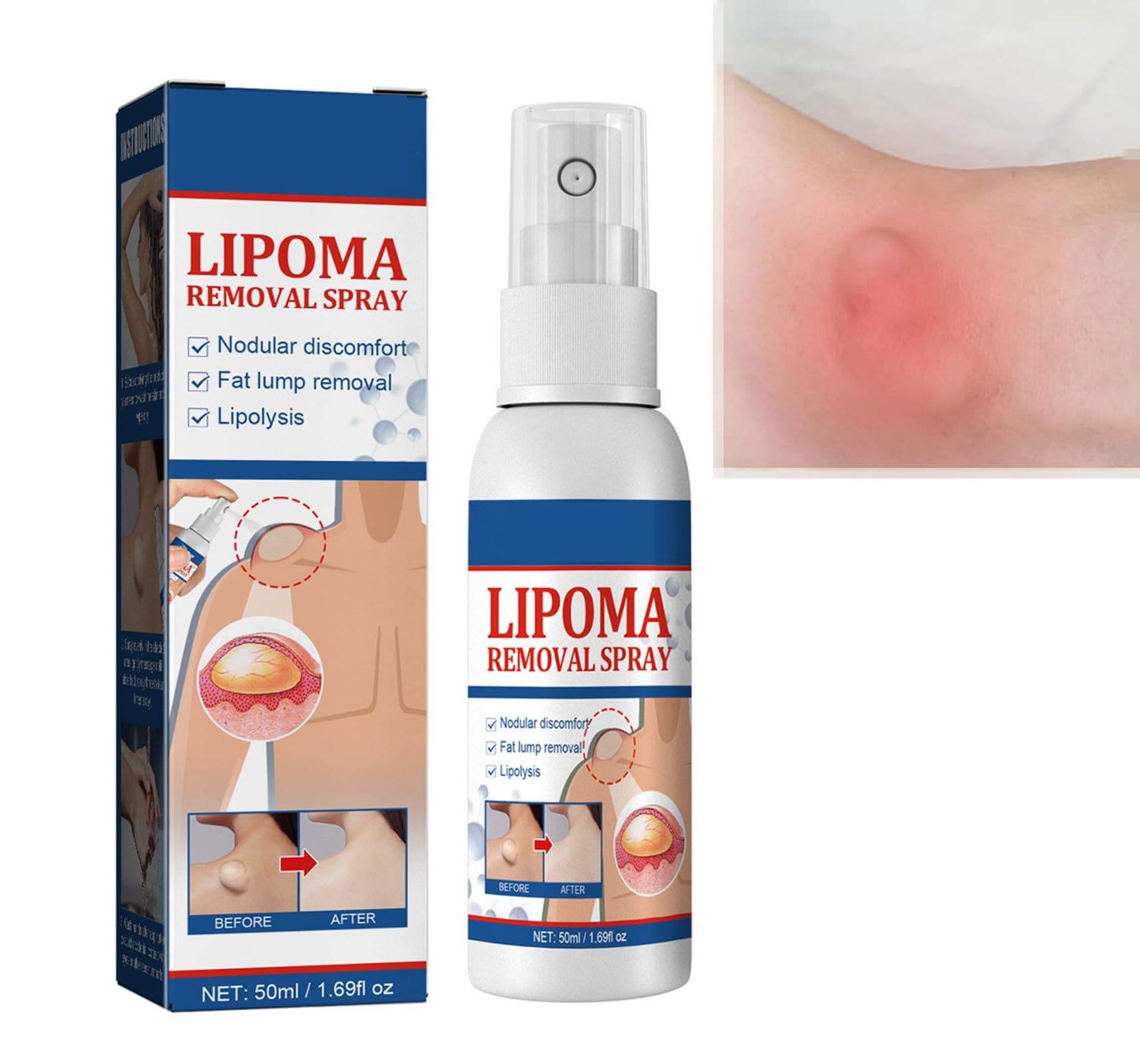 Rakiuty Lipoma Removal Spray,Lipoma Reduction,Anti-cellulite Body Shaper Spray for Men and Women, 50ml